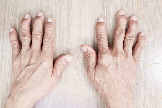 Wat zijn de symptomen van artrose?
